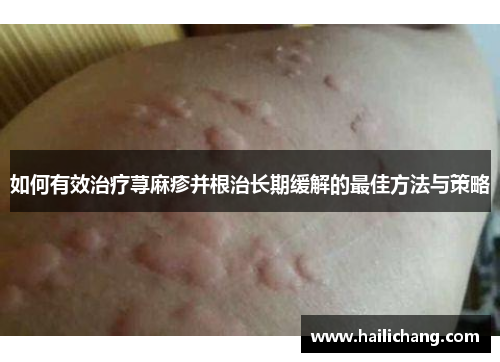 如何有效治疗荨麻疹并根治长期缓解的最佳方法与策略